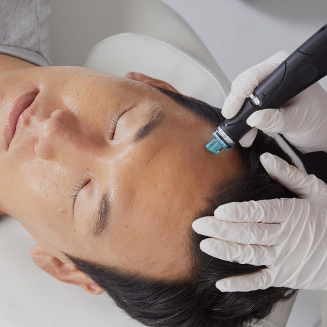Hyrdafacial® Behandlung der Kopfhaut eines Mannes